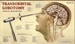 VERY HIGH PITCHED lobotomy sound effect - Sound