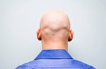 Male Patterned Baldness