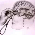 lobotomy slow