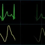 Ekg Sounds + Versagen + Slowed